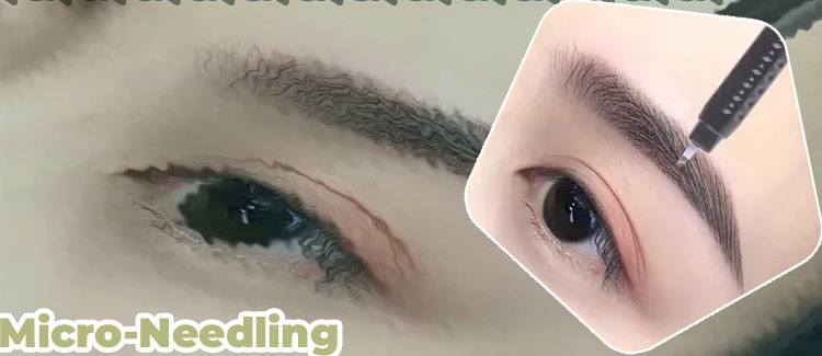 Eyebrow needling